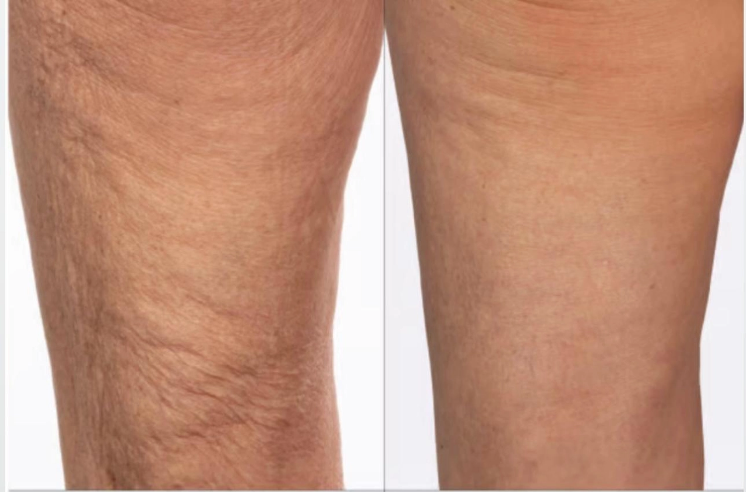 Spirit of Beauty – Beate Heinig – Wellness- und Schönheitssalon – Ergebnisse von Body Farming